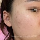 범계 한의원 :: 범계 큐티셀 스킨부스터 관리 인생 첫 큐티셀 솔직후기