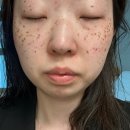 부산피부관리 하단괴정얼굴관리 로우뷰티 플라즈마 기미제거 후기 관리법 연고추천