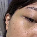 논현사우나 | 논현피부과에서 줄기세포피부주사 맞고온 후기
