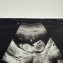 11주 6일 태아 각도법 봐주세용 이미지