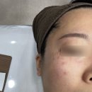 김피부과의원 | 사당역 그리니피부과의원/ 기미잡티 제거 1회차 후기 내돈내산