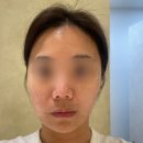 블루라인 | 압구정로데오피부과 튠페이스효과 블루 턱라인 리프팅 내돈내산 후기