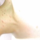 저희 오빠 사진인데요! 이거 수두 맞아요?ㅠㅠㅠㅠ갑자기 몸에 막뭐가났어요 오빠몸에;;사진있어요! 이미지