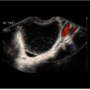Hemorrhagic ovarian cyst 이미지