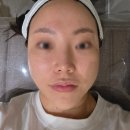 스키니크의원 | 스키니크의원 아쿠아필 인모드FX 후기 : 30대 피부관리, 모공청소, 리프팅, 주름개선 효과 직접 체험!