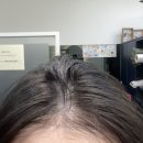 블랭크smp | 탈모전문 미용실 추천👍🏻 [블랭크유] 가르마 숱채움/정수리&amp;헤어라인smp 시술 후기, 시술 가격, 정보, 주차