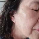 고운동침례교회앞 | 수원 닷블레스유｜수원역피부관리 잘하는 곳 잡티 편평사마귀 완전 제거 리얼 후기