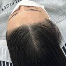 강남헤어라인교정 닷센스 서초 후기 , 헤어라인교정 변화