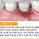 잇몸출혈 치주질환 치은염의 원인과 증상 이미지