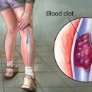 심부정맥 혈전증[deep vein thrombosis] 이미지