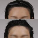라인 | [강남/압구정]헤어라인 모발이식 후기