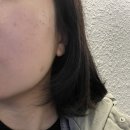 화접몽한의원 | 화접몽한의원 강서목동ㅣ임산부 편평사마귀 제거 후기_화접몽한의원 강서목동 내돈내산 후기