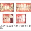 아이비라인 이미지