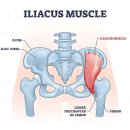장골근 대퇴신경통증 접근 이미지
