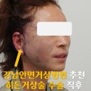 늘어진얼굴 리프팅하는 40대안면거상술 Q&amp;A [아름다운세상의원 / 성형외과]