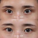 그레이스오앤영성형외과의원 | 아이홀 지방이식 구조를 먼저 보는 그레이스성형외과