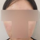 리버스의원 수원점 | 수원시청역피부과 다운타임없는 잡티제거 색소관리 피코슈어토닝 후기