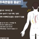 척추측만증 증상과 교정기 사용법 이미지