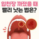 입천장 빨리 낫는법 5가지 : 까짐 부음 아픔 물집 염증 데임 헐었을 때 대처 방법 이미지