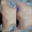 웨딩스쿨결혼전문영남 | 동탄반석산에코스쿨 예비신부 등드름원인 및 여름등드름색소 없애는법