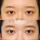 218 | 눈 성형 218. 겹쌍꺼풀 수술 후기, 비용, 전문, 외과