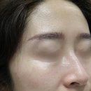 대전피부관리 세이스파 프락셔널 홀인원 레이저와 수기관리 후기