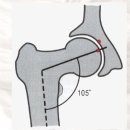 The Femoral Neck 이미지