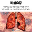 폐조직이 굳어가는 질환 폐 섬유화 증상 및 치료 방법 : 간질성 폐 질환 이미지