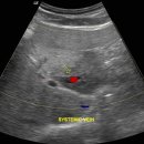 Focal fat sparing area in fatty liver에 대한 이미지