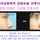 코필러주사 비용 유지기간, 부작용 궁금해요. 대구성형외과 코성형수술, 쁘띠성형 이미지