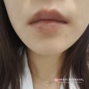 대구 칠곡 가톨릭 피부과 의원에서 접촉성 구순염(입술염) 치료 후기