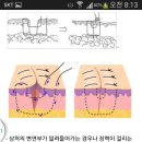 상처별 봉합 방법 이미지