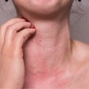 알레르기 이미지