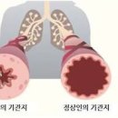 숨쉬기가 힘들어요 원인 5가지 이미지