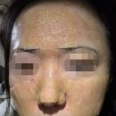 여드름 흉터치료 3회차 시술 후기 (니들알에프 2회차) _ 내돈내산 리뷰