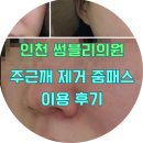 더줌의원 | 내돈내산) 구월동 썸블리의원 기미 주근깨 줌패스 4회 이용후기