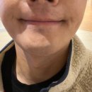 더줌플러스 | 남자 피부과 내돈내산 솔직 후기! 젠틀맥스 프로 플러스 제모 3회차 + 올포유 피코슈어 줌패스 5회차