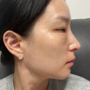 홍대 피부과 폼미코 실리프팅 필러, 메부리코 교정 전후비교 솔직후기