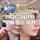 멍스타일 | 인천논현피부과 인모드 포마 탄력 리프팅 (멍 ,통증 상세후기)