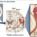 뇌졸중은 무엇입니까? 이미지
