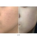 멍스팟 | 분당 서현 피부과에서 레이저토닝 받은 찐 후기 색소치료 아꼴스팟 효과는?