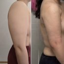 으라차차멍 | 압구정탑라인 - 팔 지방흡입 1일차 후기