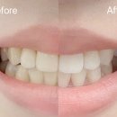 옥치과의원 | 치아미백으로 광명찾은 후기! 동대문구 미백치과