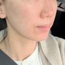 수 가정의학과의원 | 대구편평사마귀 제거 신세계가정의학과의원 AS 후기 내돈내산