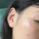 한독의원 | 레이저토닝 부작용 효과 후기 모낭염 가려움 홍조 주기