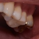 제천연화치과기공소 | 추석 송편 떡먹다가 빠진 금니, 맞지 않으면 세라믹 온레이,이맥스인레이