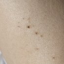 수목요양병원 | 20대 팔뚝 대상포진 후기, 증상, 운동 언제부터? 🥹