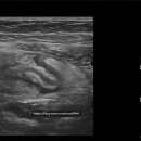 삼송성모내과의원 | [삼송성모내과]설사와 복통으로 내원하여 맹장염이 확인된 증례(급성 충수염)