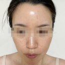 밝은해한의원 | 피부 진료 전문 한의원에서 흑자 색소침착 편평사마귀 제거 후기 (비포애프터, 1~4주차)