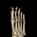 성가한의원 | 발가락 골절 후기 x-ray로 보는 회복 과정, 추천하는 음식